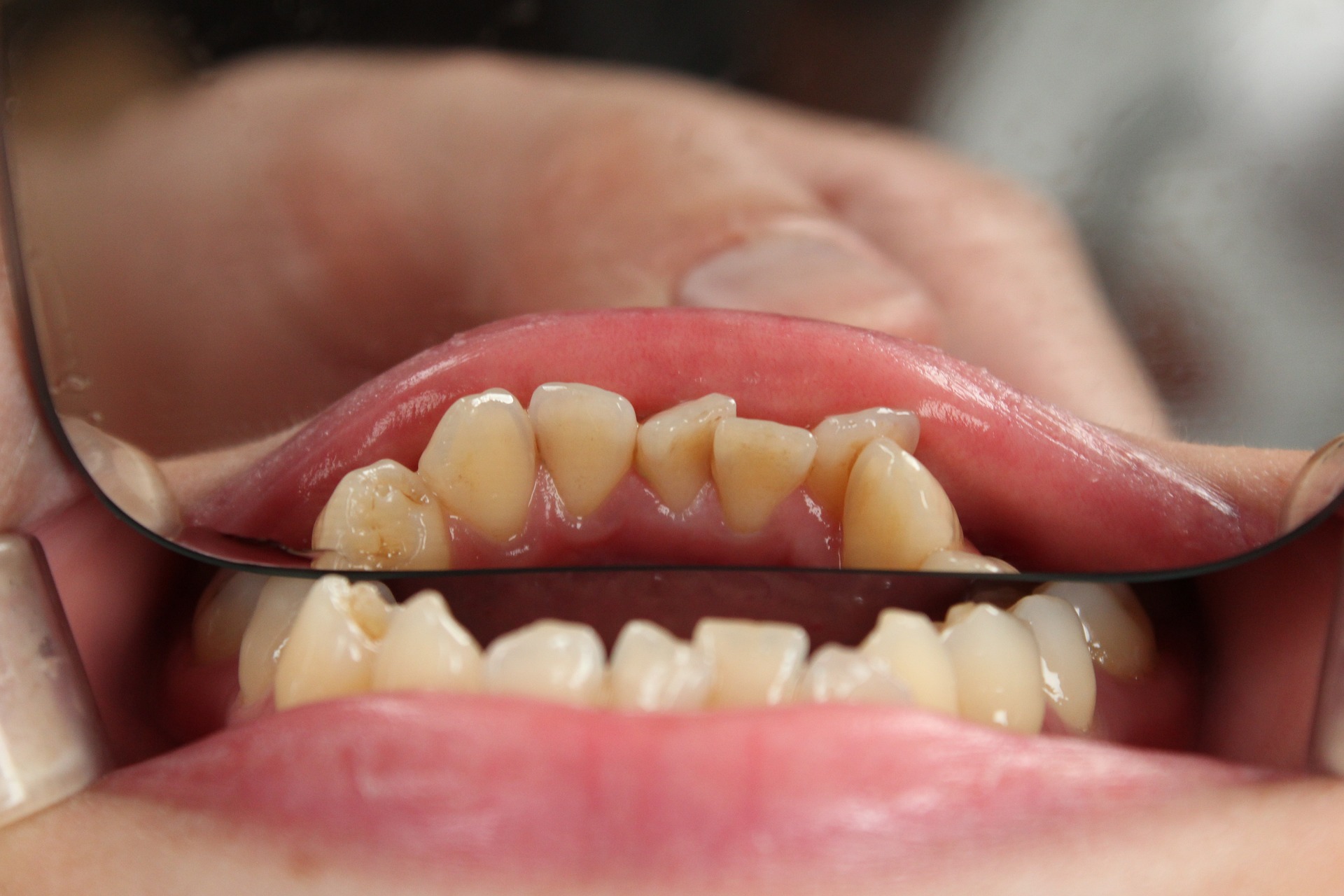 顎関節症になりやすい歯並び
