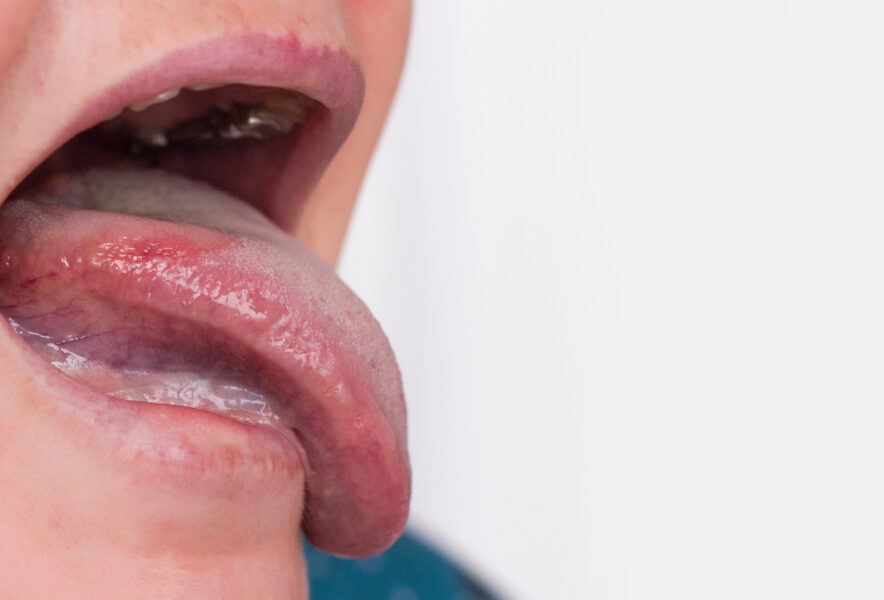 舌もカンジダになるって本当？口腔カンジダ症の治療や予防について徹底解説！