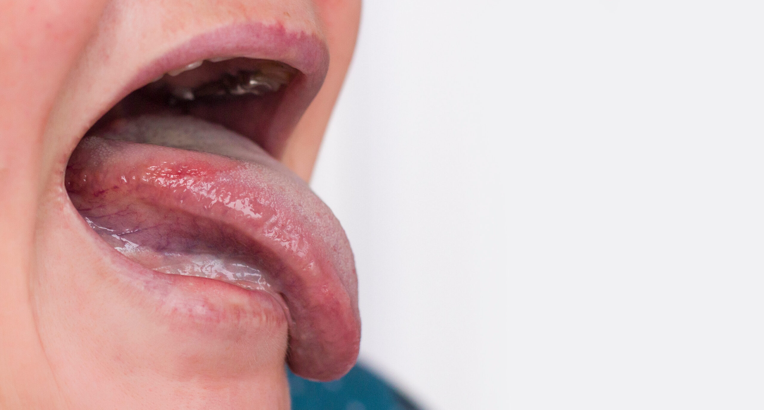 口腔粘膜疾患の具体的な症状