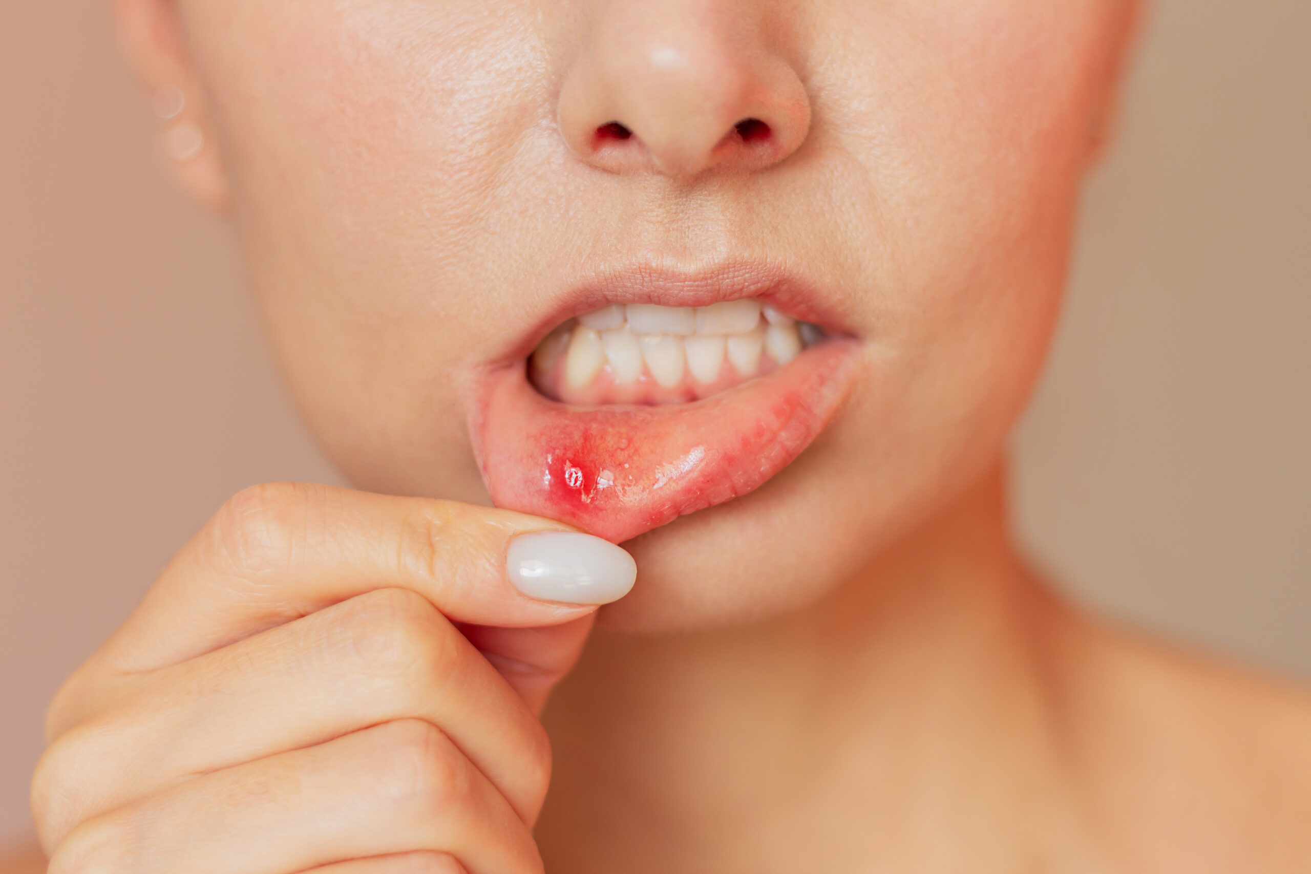 口腔粘膜疾患と口内炎について