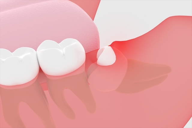 親知らずが真横の状態で生えてくる原因とは？抜歯の判断基準や放置するリスクを解説
