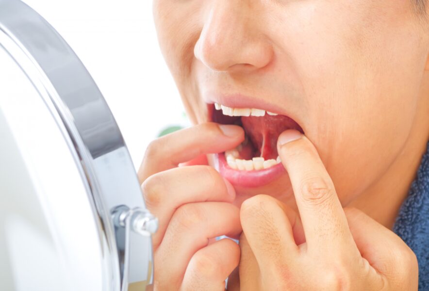 舌や歯茎にできる白板症とは？口腔がんとの関係や治療方法について解説！