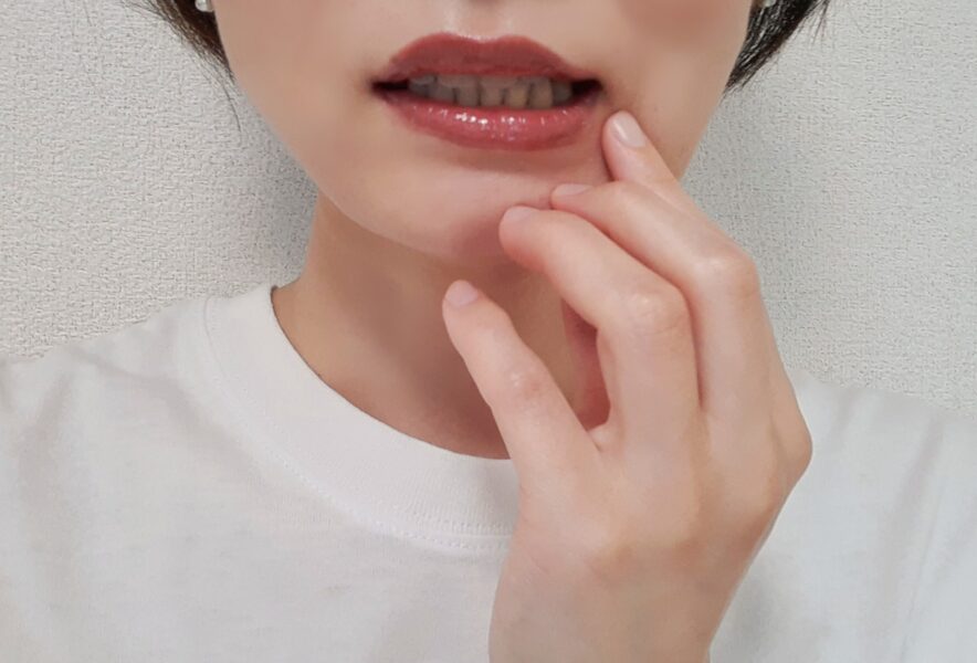 粘液嚢胞を自分で潰すのは危険？粘液嚢胞ができる原因やできた場合の対処方法、治療方法を解説